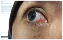 Antibiotic and steroid combination eye drops