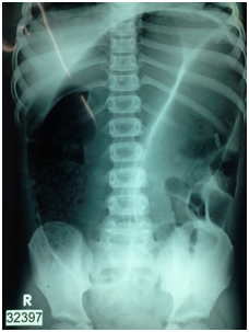 Sigmoid Volvulus Causing Intestinal Obstruction in A Child ...
 Volvulus X Ray Omega Sign