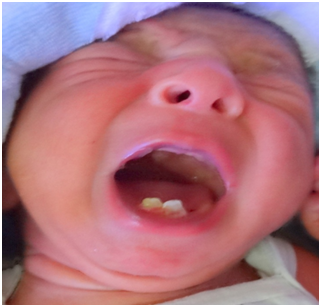 Neonatal teeth - Wikipedia