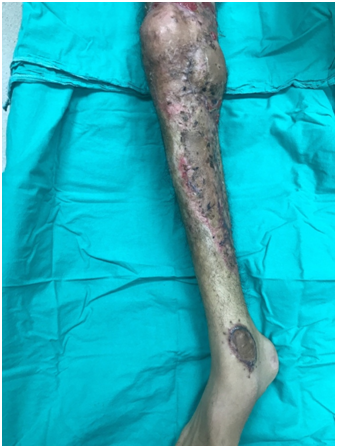 Using medial gastrocnemius muscle flap and PRP (Platelet-Rich-Plasma