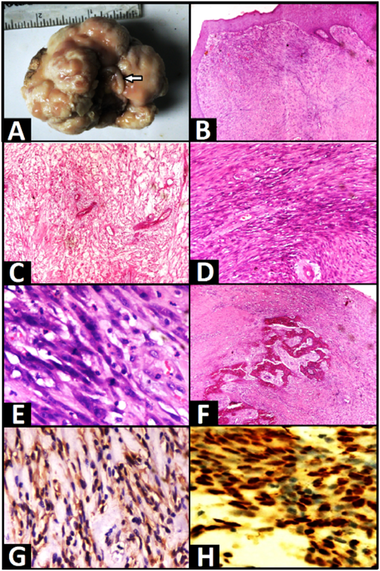 Cellular Pseudosarcomatous Fibroepithelial Stromal Polyp Of The Cervix