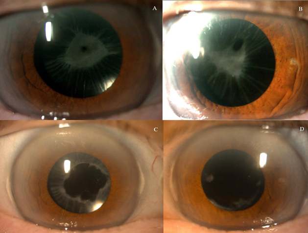 Bilateral Anterior Capsular Phimosis In An 85 year old Female Patient 