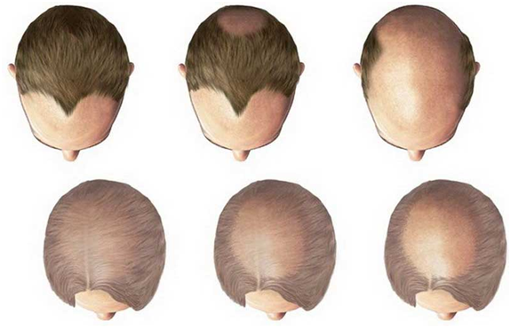 Androgenetic Alopecia  hair Loss type  best Hair Transplant clinic in  India