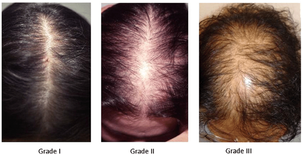 The role of mutations on gene AR, in androgenetic alopecia syndrome -  MedCrave online