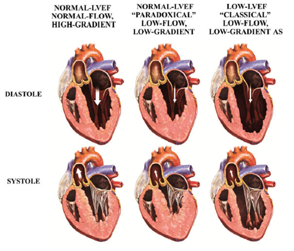 Paradoxical Aortic Stenosis Much More Than A Classification Problem 