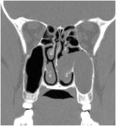 Antrochoanal Polyp Medcrave Online