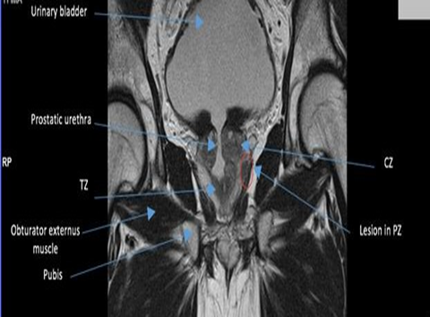 Prostate Radiological Anatomy Prostate Radiological Anatomy