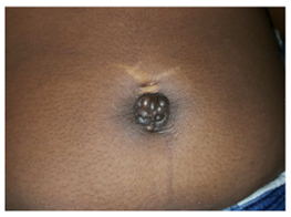 Menstruating primary umbilicus cutaneous endometriosis: A case report and  review of literature