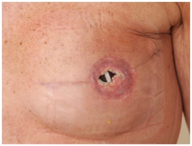 Indications for medical tattooing in breast-reconstructed patients -  MedCrave online
