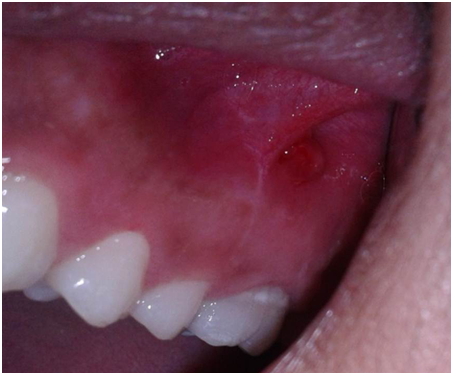 The effect of traumatic occlusion on healing of periapical lesion: a ...