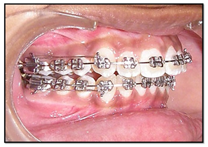 settling elastics in orthodontics