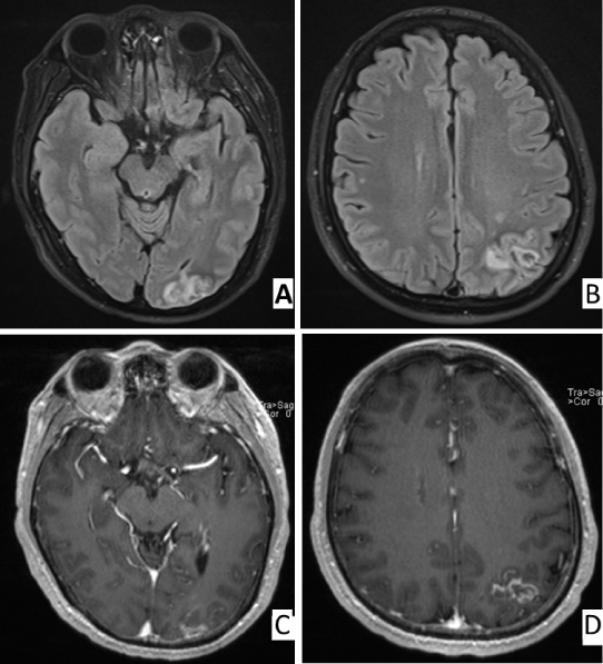 Oscillopsia In Middle Cerebral Artery Dissection A Rare Presentation