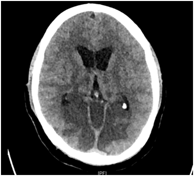 Basilar Artery Ischemic Syndromes- A Brief Discussion of Current ...