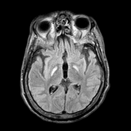 Nucleus ventralis oralis anterior a potential target in deep brain ...