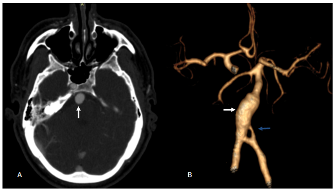 Fusiform aneurysm of the basilar artery associated with internal ...