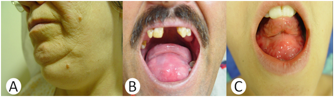 Figure 5 Dermoid Cysts Of The Floor Of The Mouth Two Case Reports