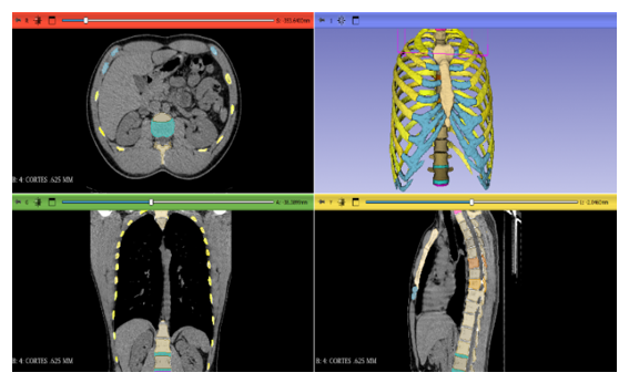 Human ribs: structure, function, and mechanical response - MedCrave online