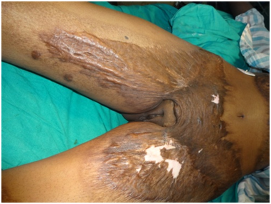 A novel perforator-based flap for reconstruction of post-burn groin  contracture - MedCrave online
