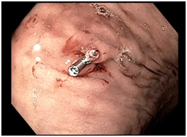 Upper GI endoscopy complication: a case of a post-gastric ...