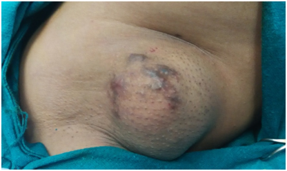 Fibroadenoma measuring 2.5 cm in an axillary accessory breast (AAB