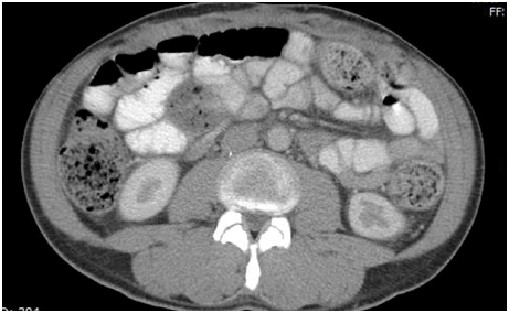 Cureus, Component Separation: A Case Report of Hybrid and Synthetic  Absorbable Mesh Use for Complex Large Ventral Hernia Reparation