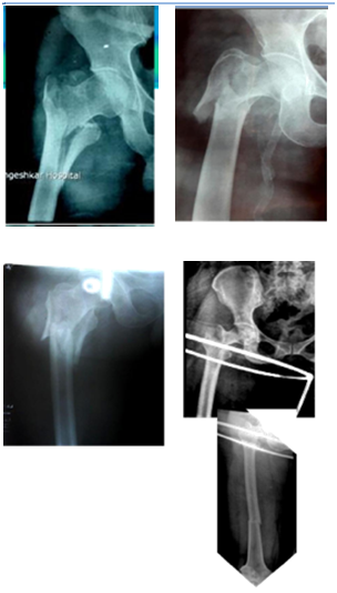 Proximal Femur Nail in Intertrochanteric Fractures Indications and Tips  Tricks | Panchanadikar | MOJ Orthopedics & Rheumatology