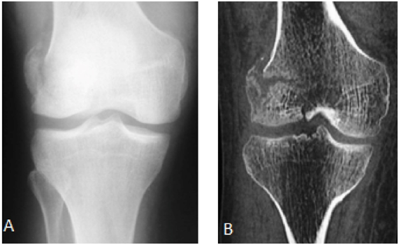Isolated Hoffa Fracture An Unusual And Commonly Forgotten Fracture Medcrave Online
