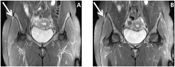 ITB ILIOTIBIAL BAND FRICTION SYNDROME MRI: IS IT A BURSA OR A RECESS? -  Radedasia