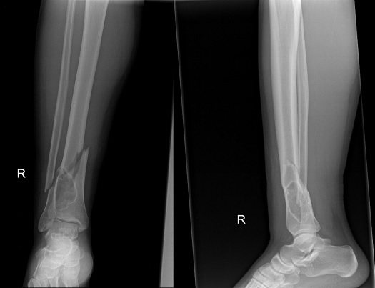 A Unique Adult-Type Distal Tibia Non-Ossifying Fibroma with Secondary ...