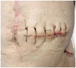 Subcutaneous drains reduce the surgical site infection after primary wound  closure in stoma reversal patients - MedCrave online
