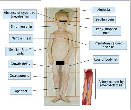 causes of progeria